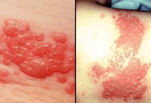 Precautions for shingles and pregnancy, managing shingles while pregnant