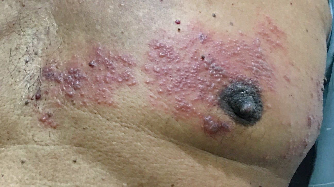 Risks and symptoms of shingles during pregnancy